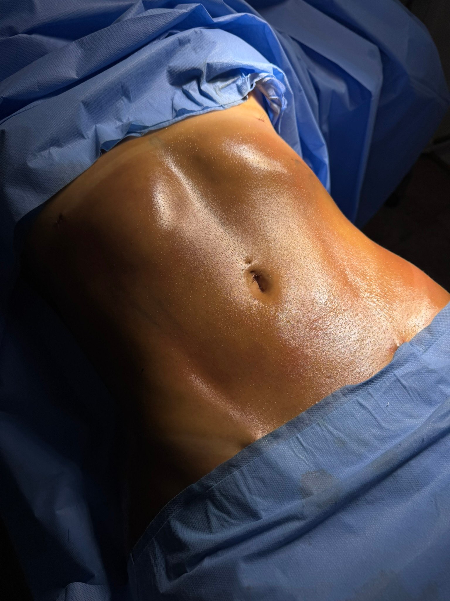 Resultado Lipo HD definição muscular — Dr. Lauro Campos Salvador