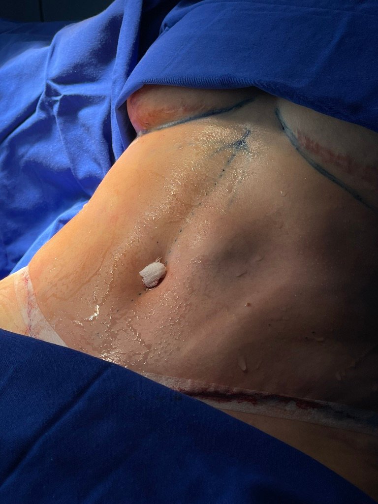 Resultado Lipoabdominoplastia HD — Dr. Lauro Campos Cirurgião Plástico Salvador