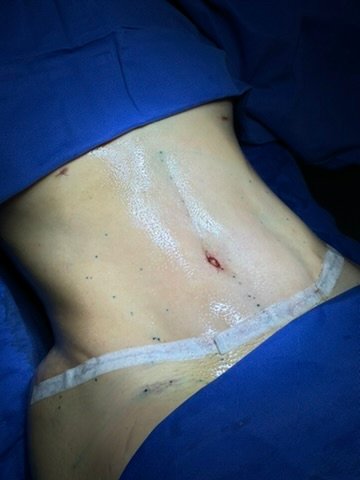 Resultado Abdominoplastia HD — Dr. Lauro Campos Salvador BA