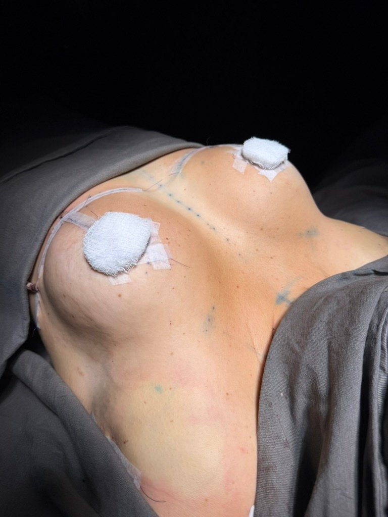 Resultado Mamoplastia — Dr. Lauro Campos Salvador